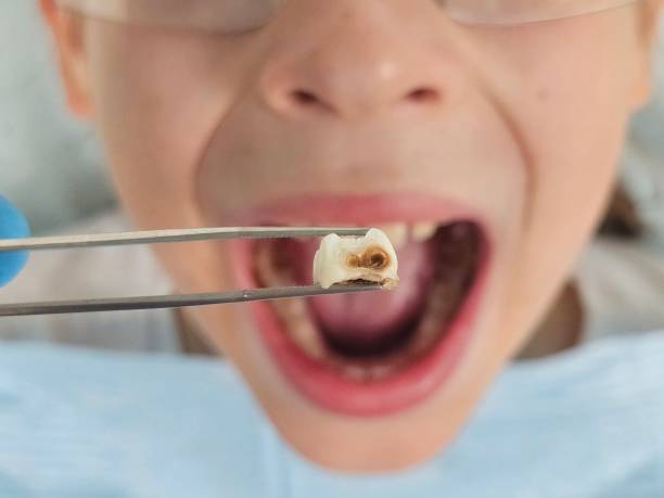 Best Emergency Wisdom Teeth Removal in Blackhawk, SD